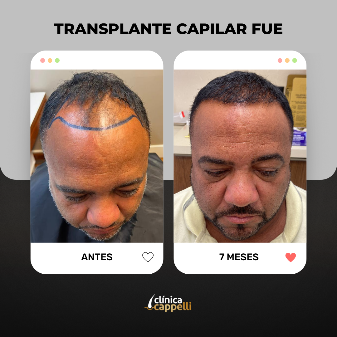 Clínica Cappelli – Transplante Capilar