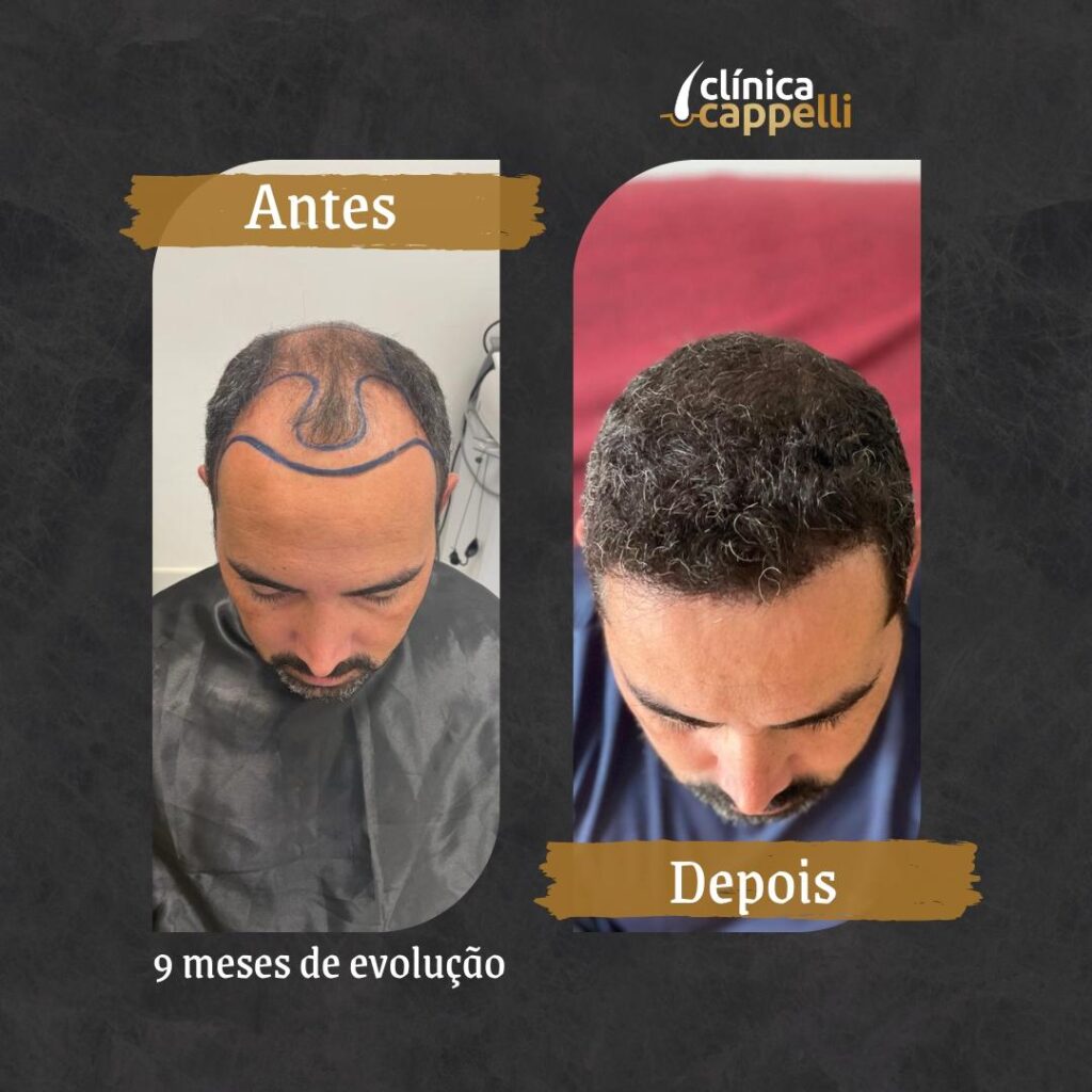Resultado de transplante capilar FUE — paciente 2