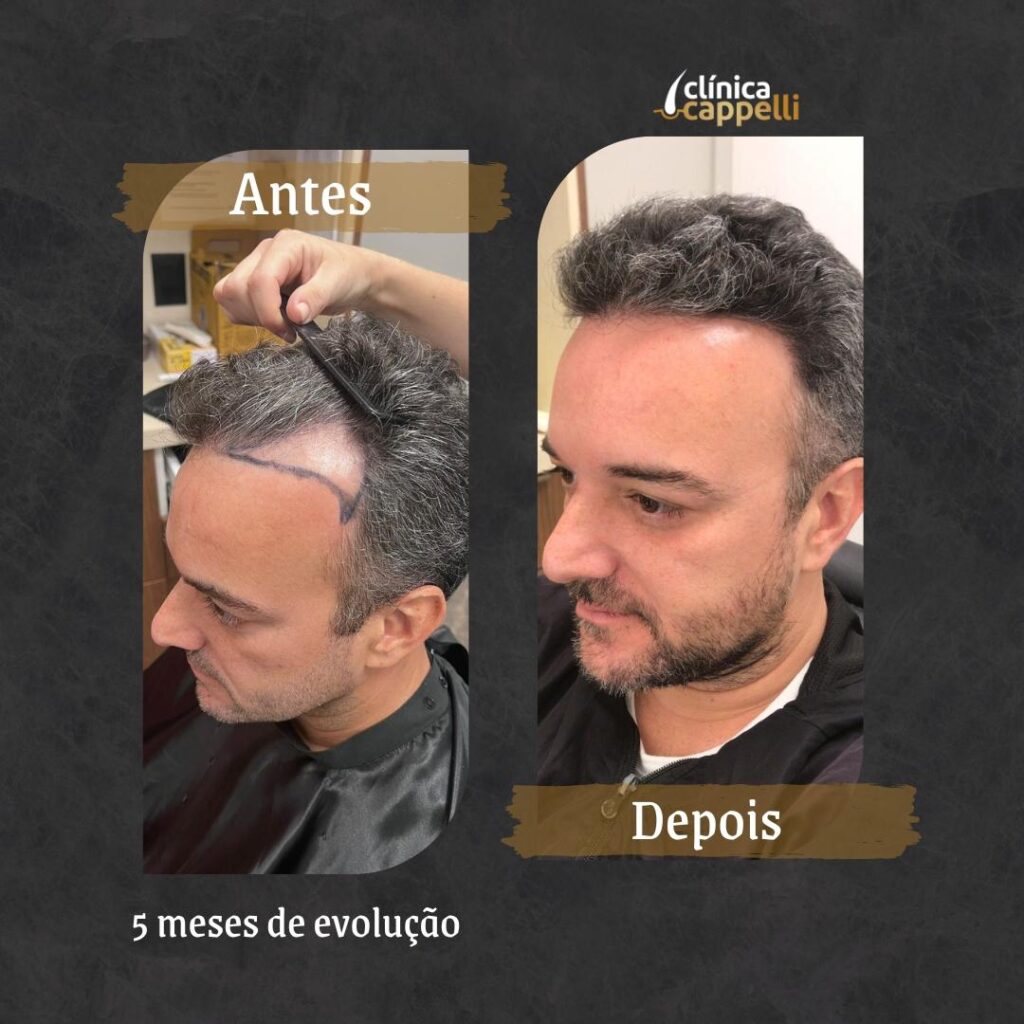 Resultado de transplante capilar FUE — paciente 1