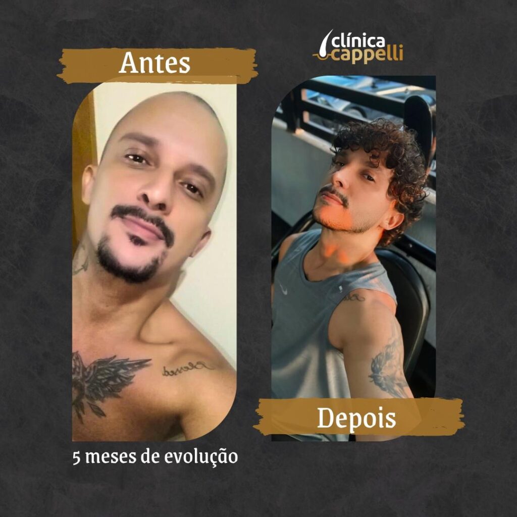 Resultado de transplante capilar FUE — paciente 3