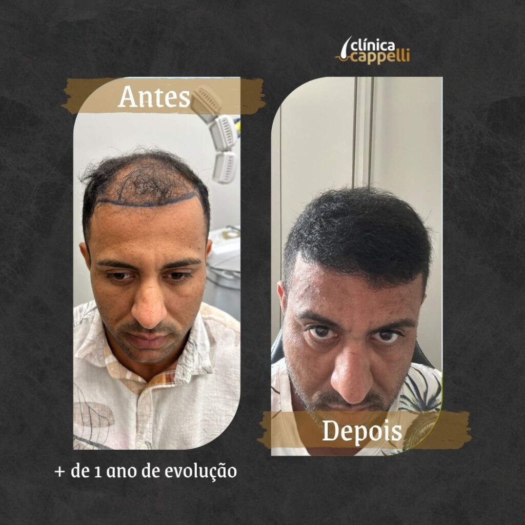 Resultado de transplante capilar FUE — paciente 4