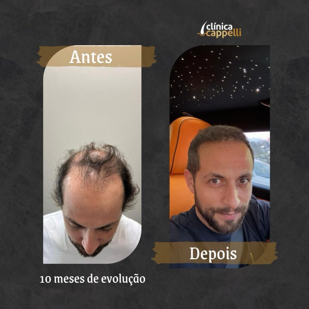 Resultado de transplante capilar FUE — paciente 5