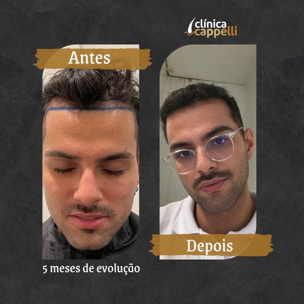 Resultado de transplante capilar FUE — paciente 6